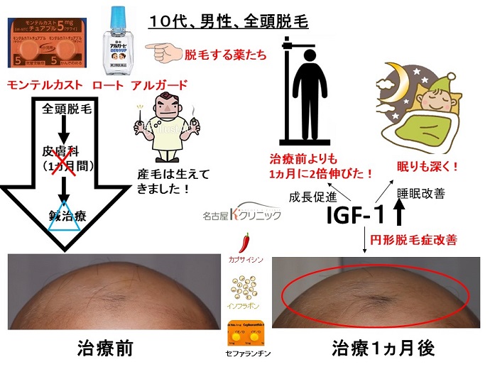 円形脱毛症　病院